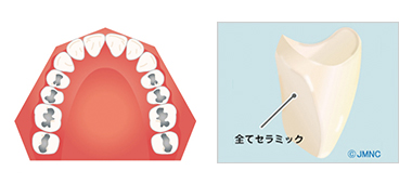 オールセラミッククラウン　イメージ画像