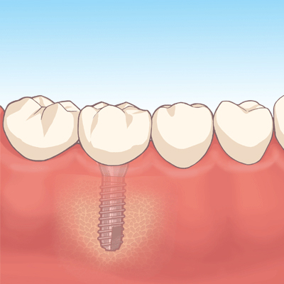 インプラント イメージ画像