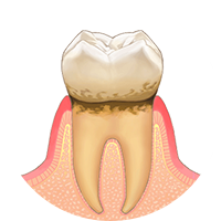 歯肉炎 イメージ画像