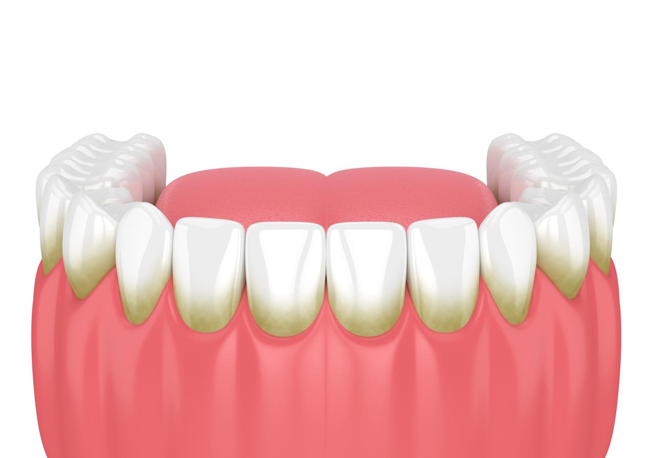歯石が付かないようするには